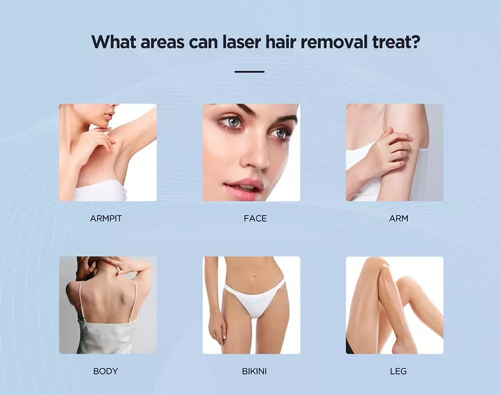 4D Teclaser Hair Removal Machine 4D Teclaser Hair Removal Machine
