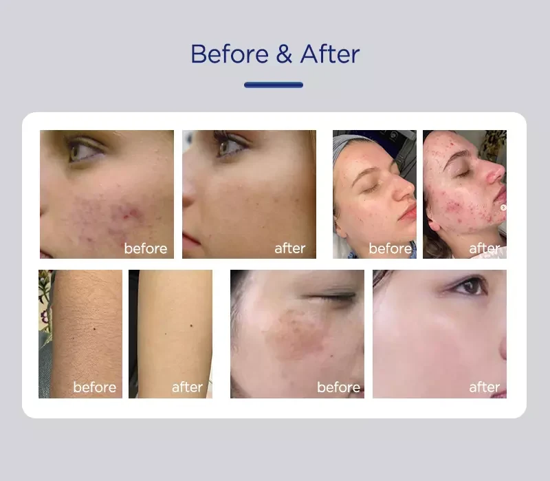 Portable Hair Removal Skin Rejuvenation Machine DPL