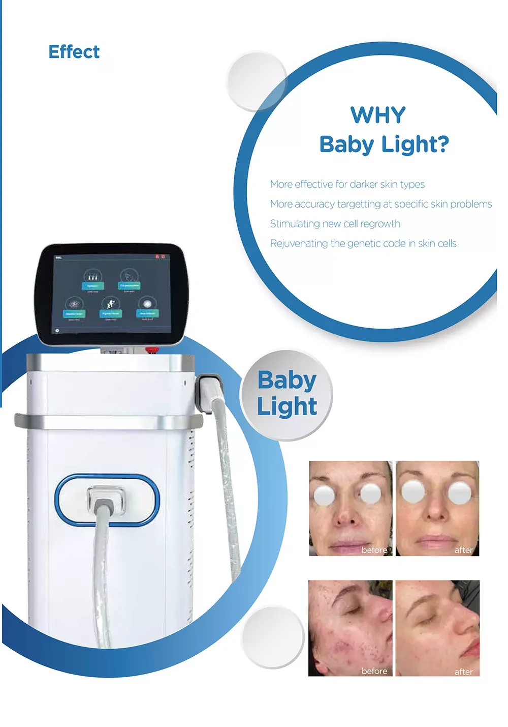 BBL Hair Removal Skin Rejuvenation Machine BBL Hair Removal Skin Rejuvenation Machine
