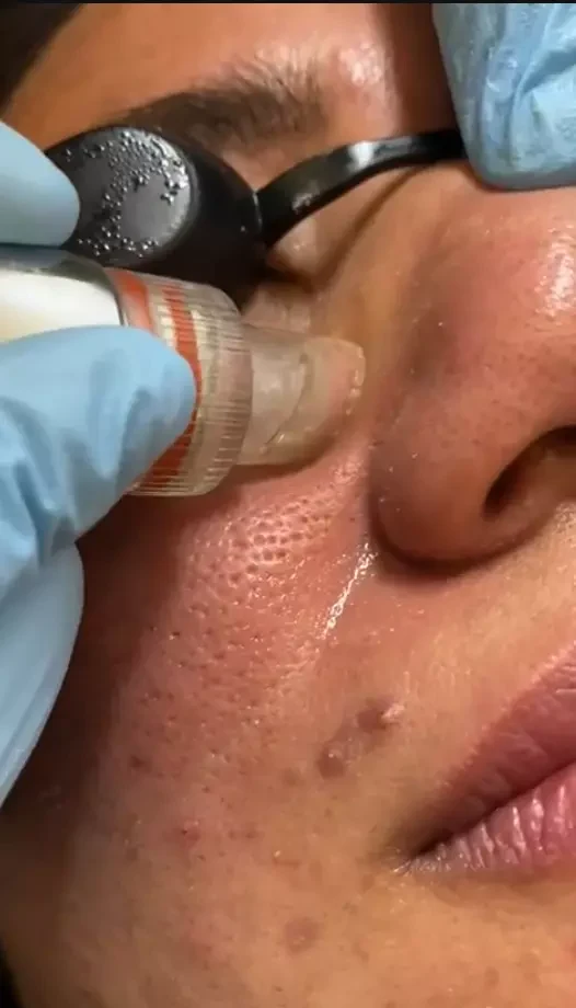 What Factors Should I Consider When Searching For A Hydrafacial Spa Near Me