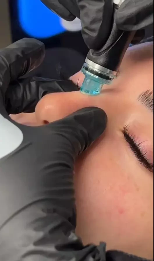 Extractions With Hydrafacial! Easy And Painless Compared To Manual Extractions 