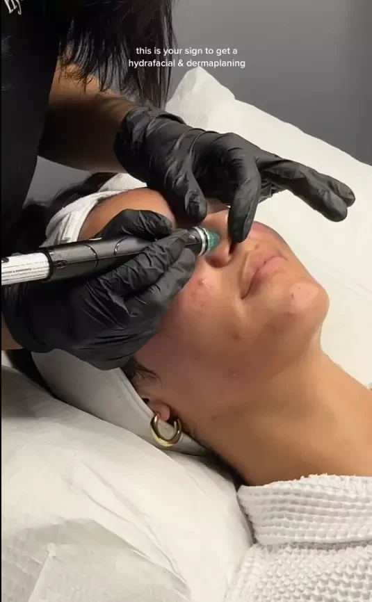 Is Hydrafacial Good For Acne