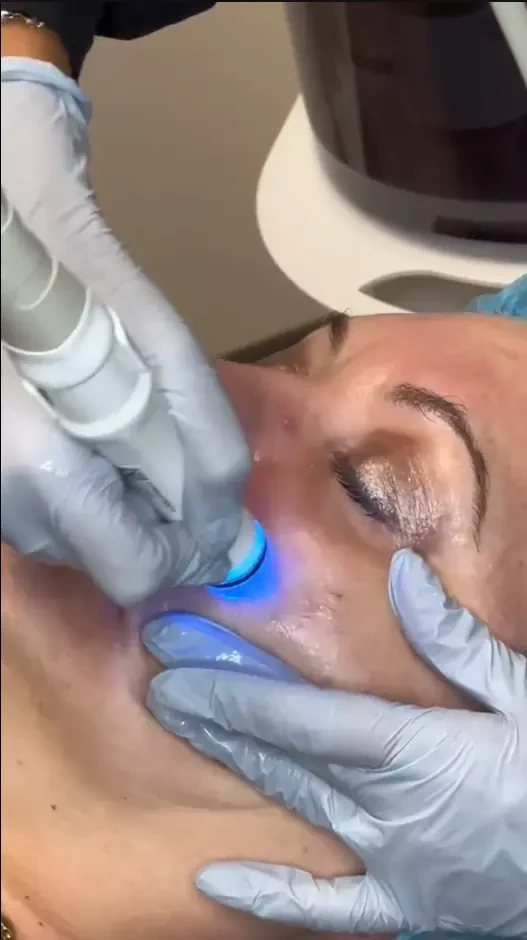 Hydrofacial Vs Traditional Facials: Why More Clients Are Choosing This Revolutionary Skincare Technology