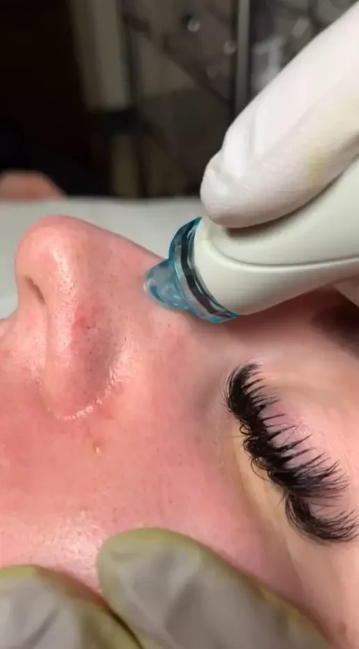 Unlocking The Science Behind Hydrofacial