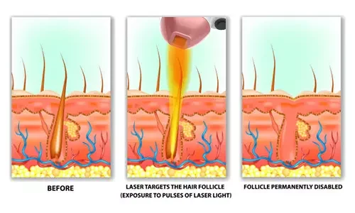 808nm Diode Laser Hair Removal SystemAdvantages