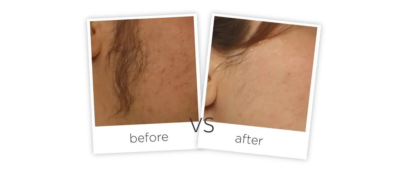 1064nm Long Pulse Laser Before&After