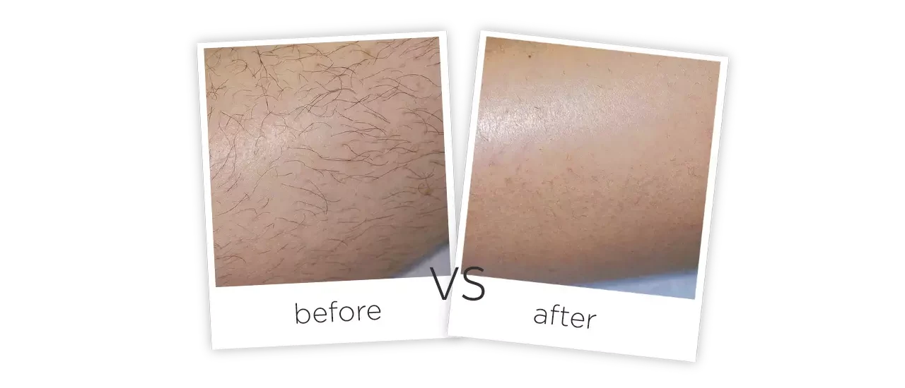 1064nm Long Pulse Laser Treatment Before&After