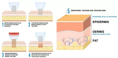 4D Skin Lifting Theory