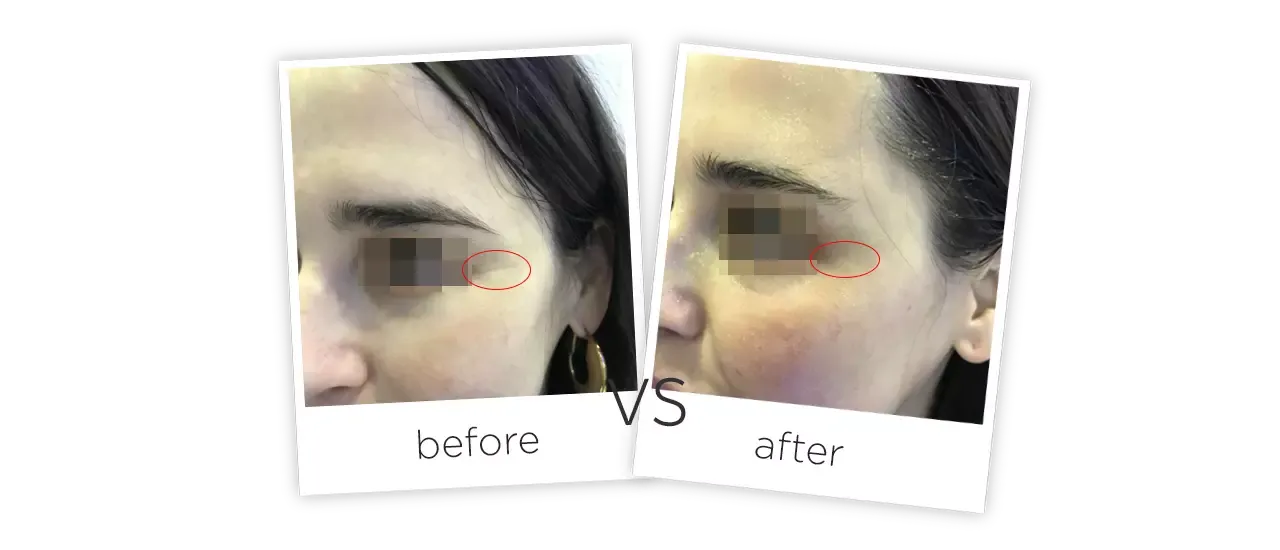 Treatment  /  Wrinkle Removal & Skin Tighten Before&After