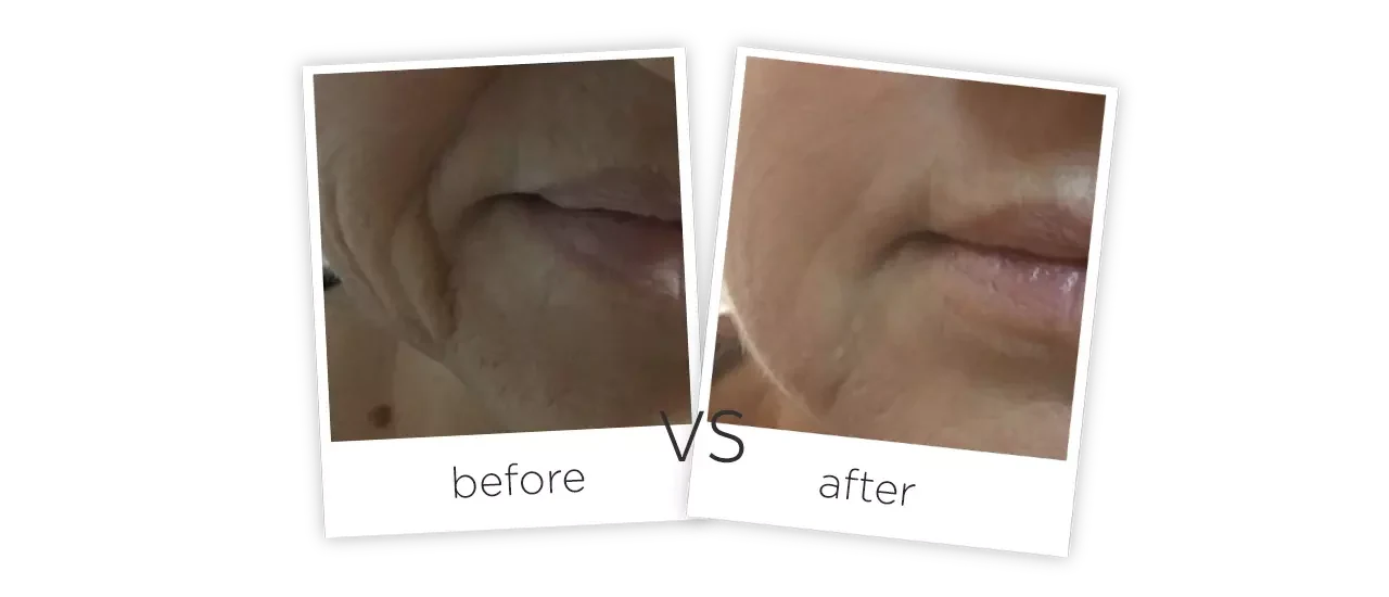 4D Skin Lifting Treatment results