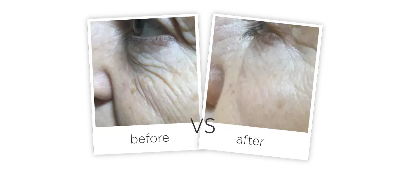 4D Skin Lifting Treatment Before&After