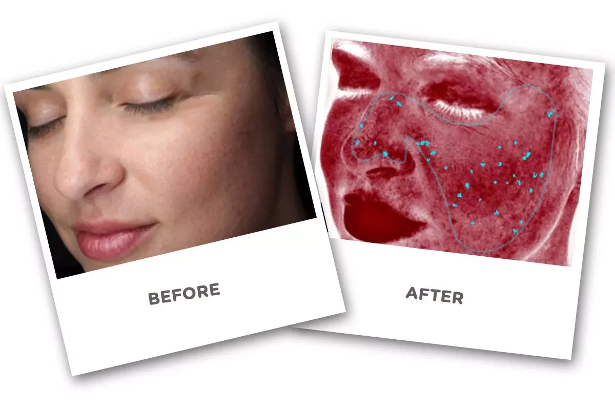Face Skin Analyzer Before and After Face Skin Analyzer Before and After