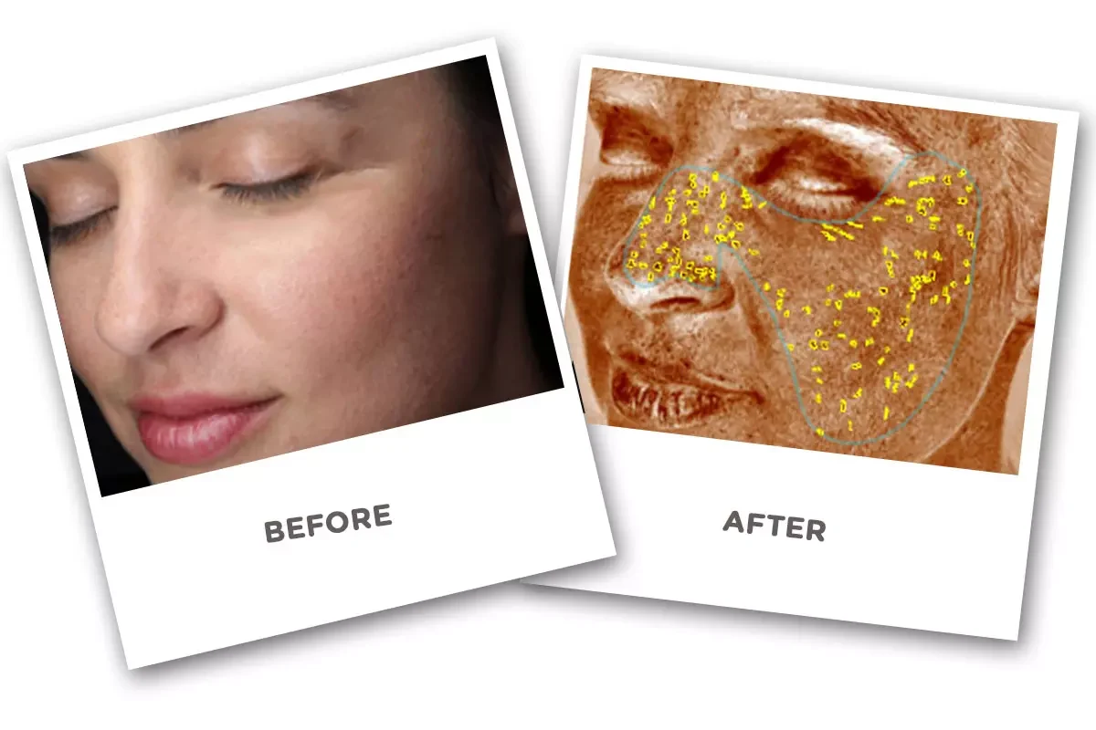 Skin Analyzer Before and After Skin Analyzer Before and After