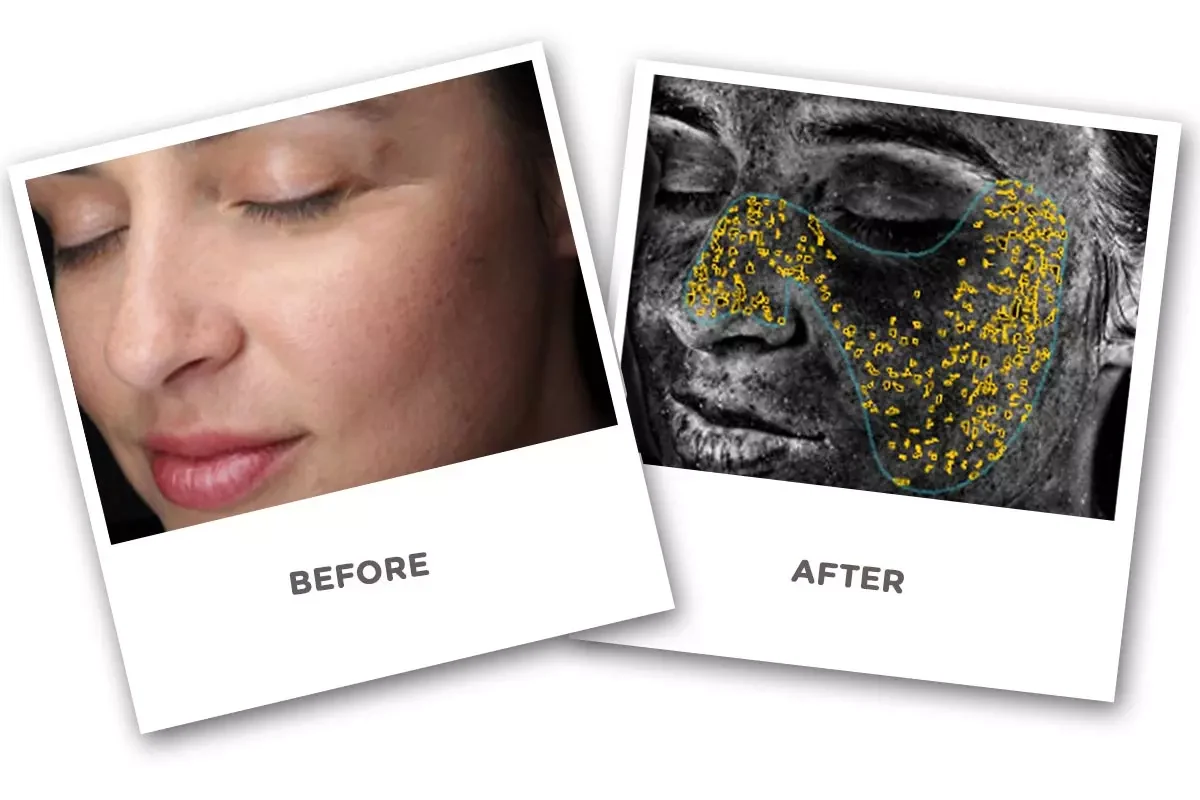 Skin Analyzer Before and After Skin Analyzer Before and After