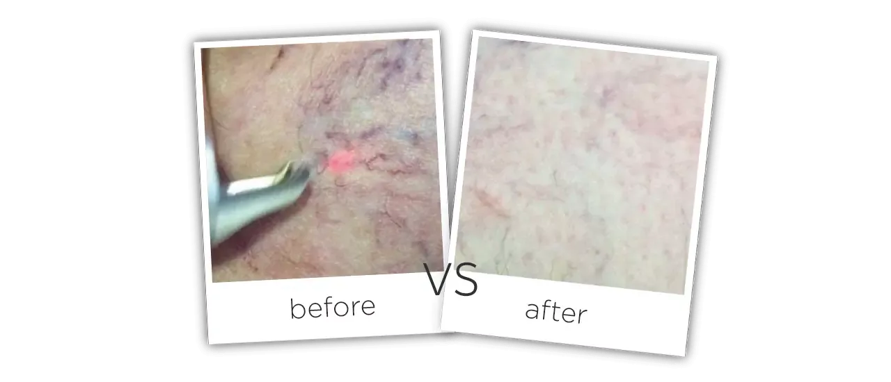Treatment  /  Spider Veins Removal Before&After