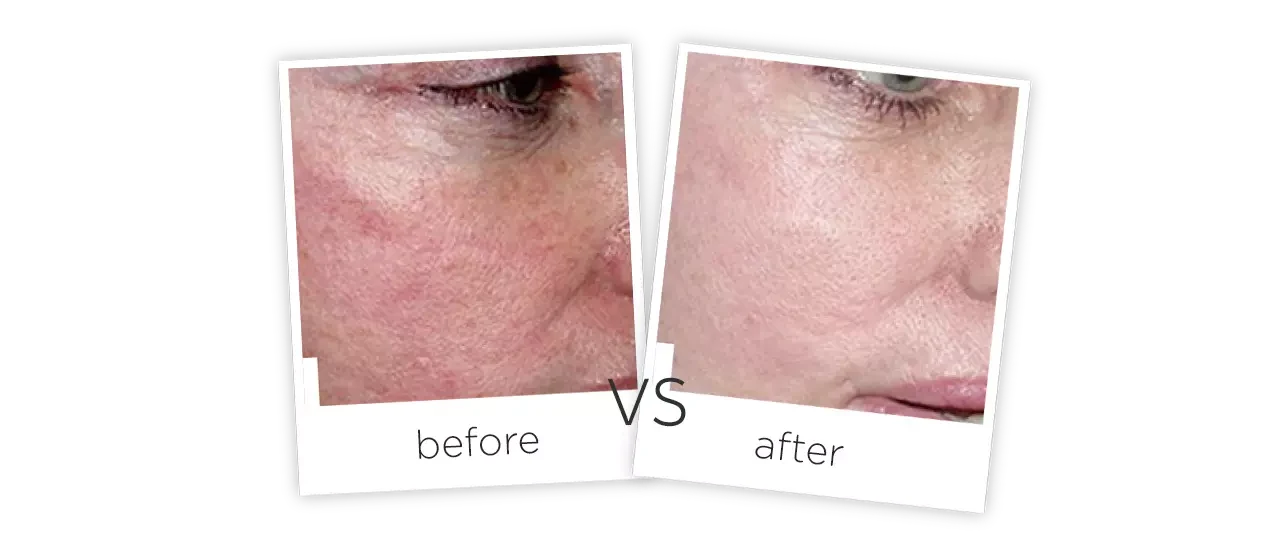 SHR spider veins removal treatment Before and After SHR spider veins removal treatment Before and After