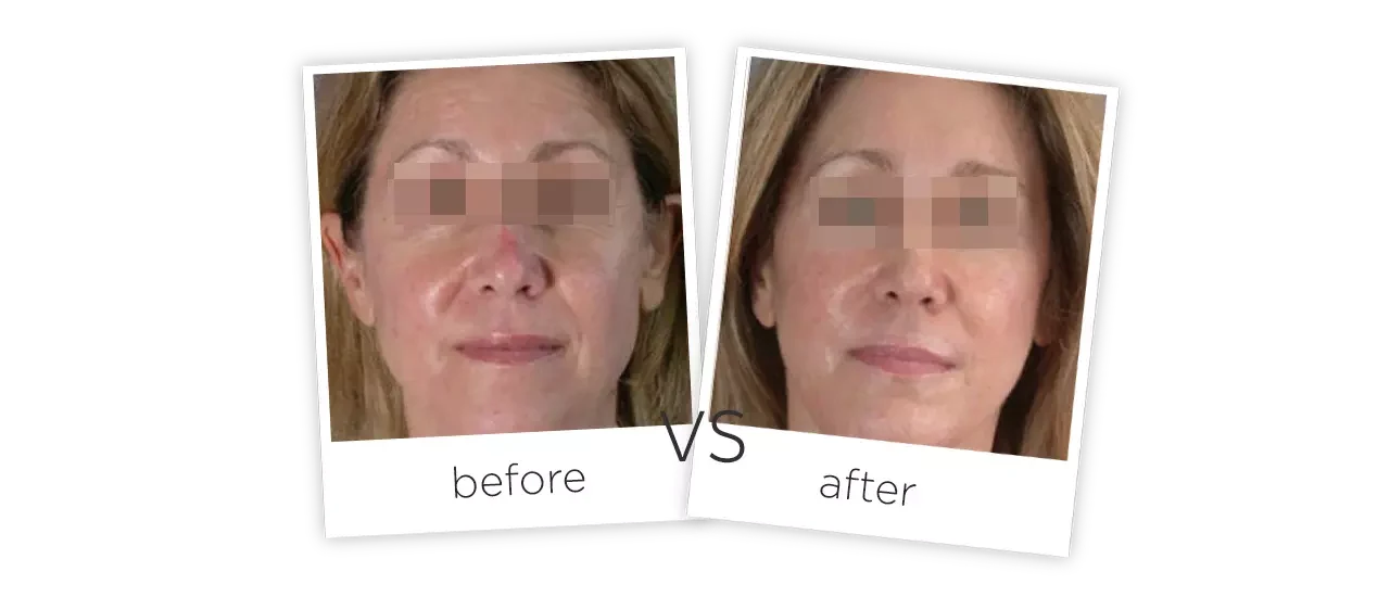 At Home Laser Spider Vein Vascular Removal Machine Treatment Before&After