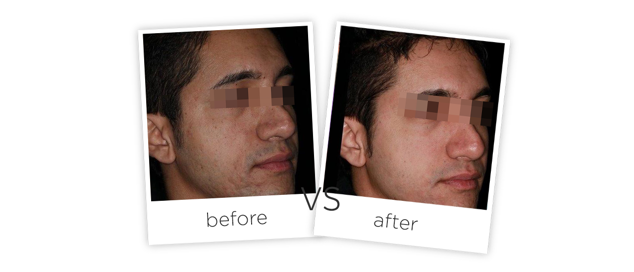 Vaginal Tightening Before&After