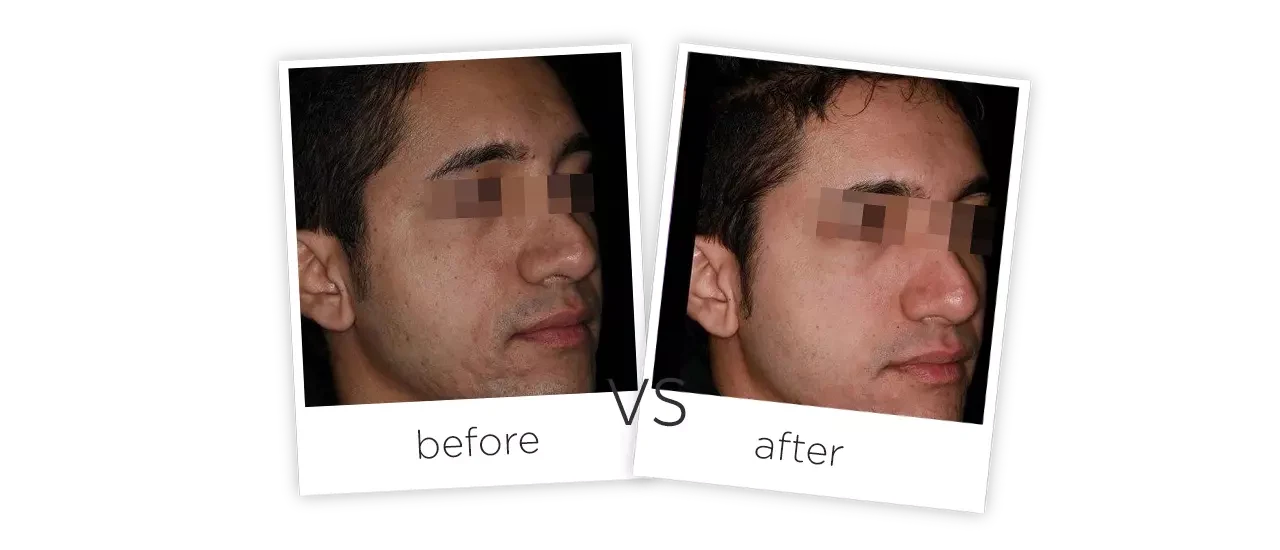 Treatment  /  Acne Scars Treatment Before&After