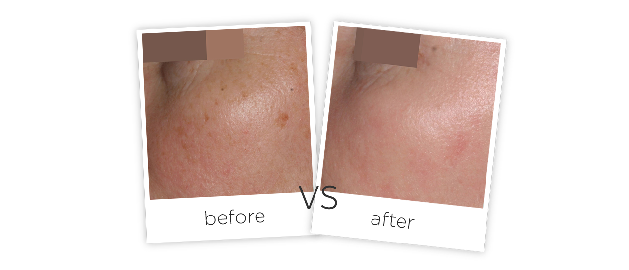 Vaginal Tightening Treatment results