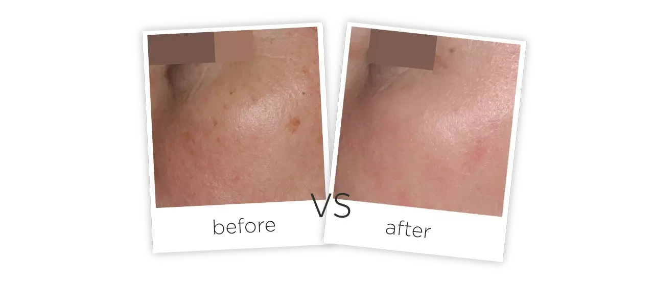 Radio Frequency (RF) Fractional Co2 Laser Before&After