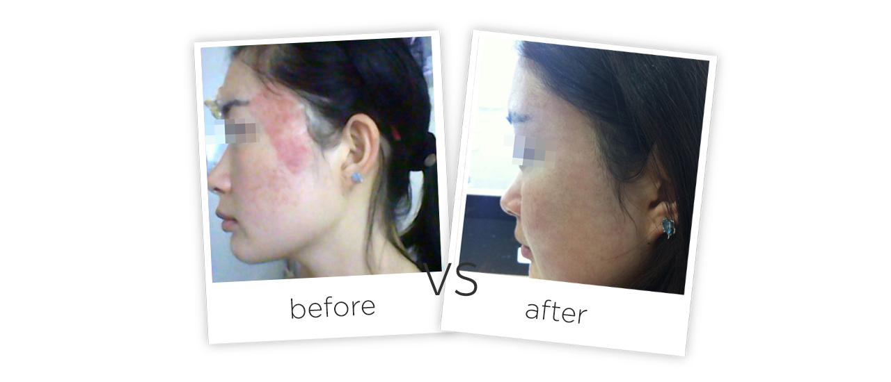 Vaginal Tightening Treatment Before&After