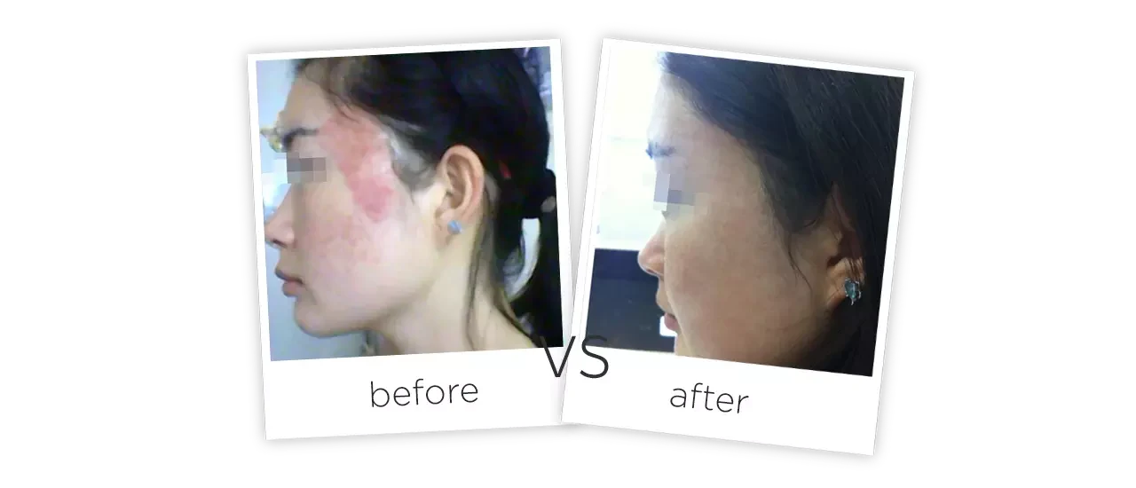 Radio Frequency (RF) Fractional Co2 Laser Treatment Before&After