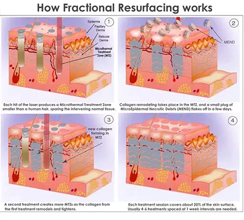 Radio Frequency (RF) Fractional Co2 Laser Theory