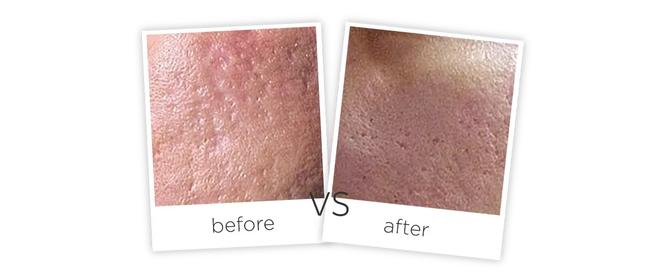 Erbium Glass Laser Before&After