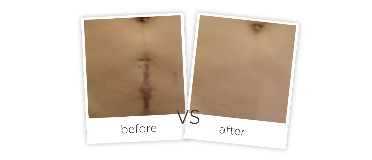 Erbium Glass Laser Treatment results