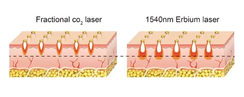 Erbium Glass Laser Theory