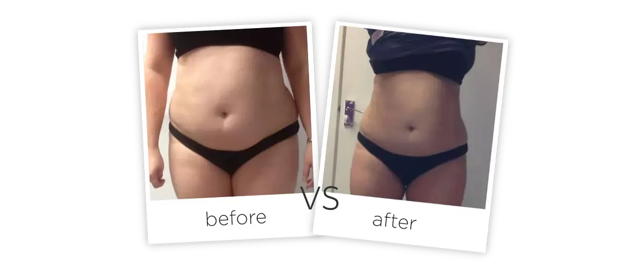 Treatment  /  Body Contouring Before&After