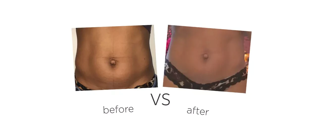 Cryolipolysis Slimming Machine Treatment Before&After