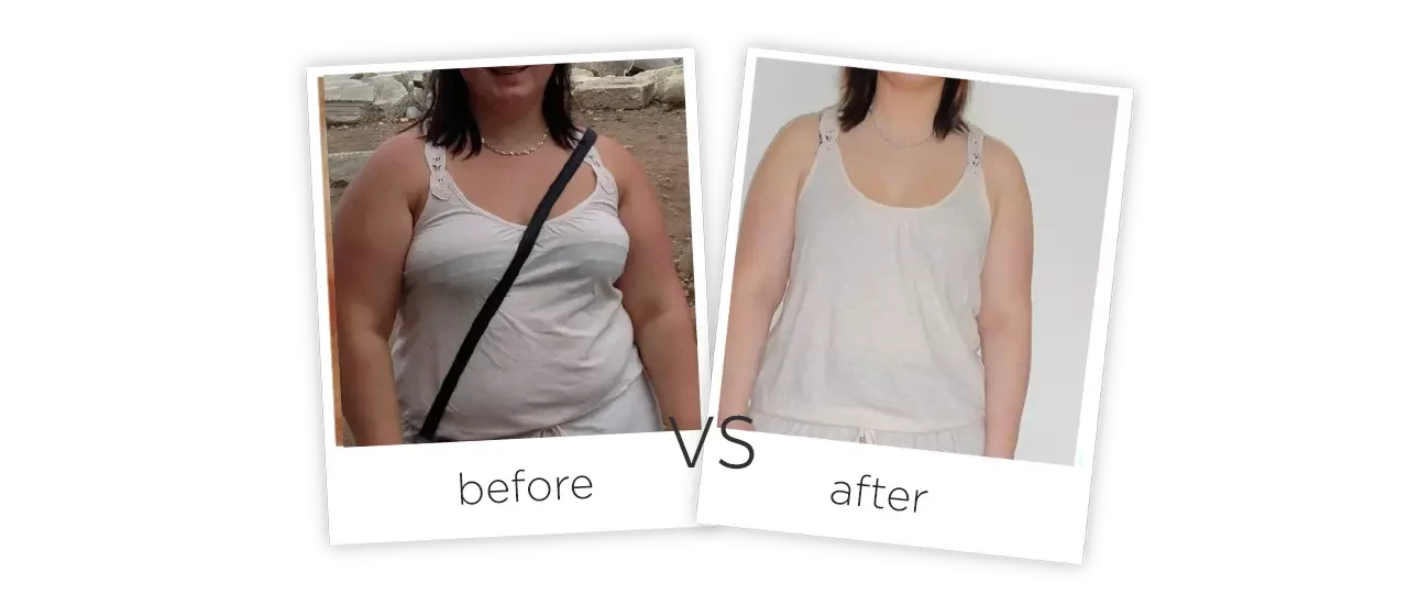 Cryolipolysis Slimming Machine Treatment Before&After