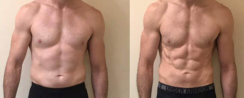 Electric Muscle Stimulator Before And After