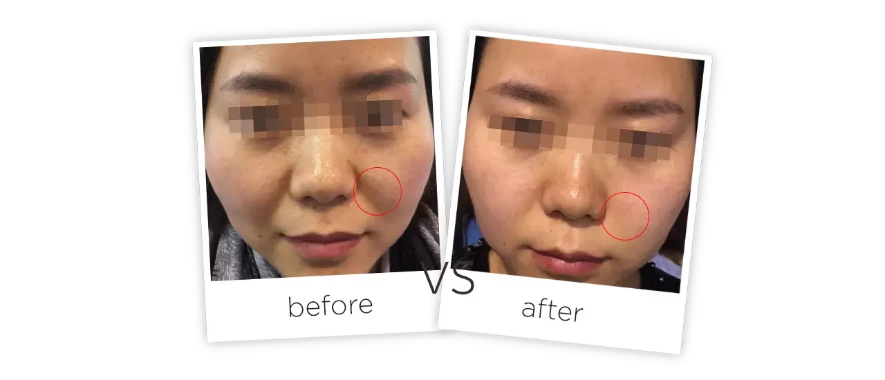 HIFU Face Treatment Before and After HIFU Face Treatment Before and After
