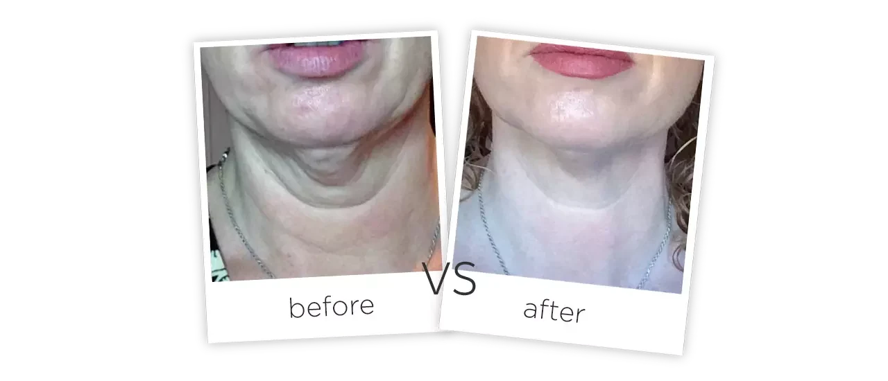 HIFU Treatment Before and After HIFU Treatment Before and After