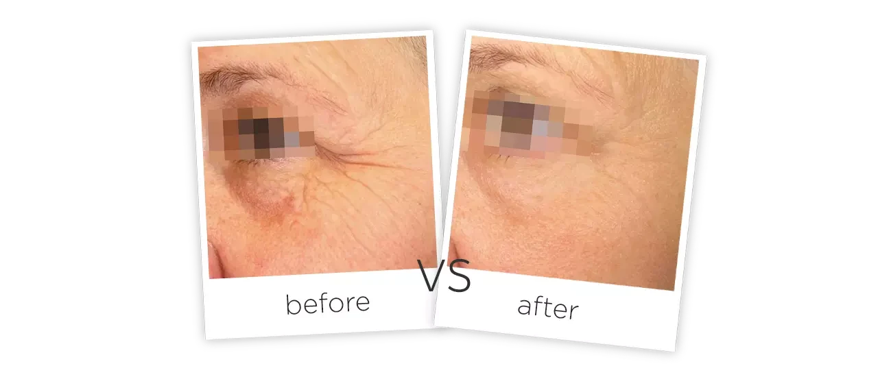 HIFU Treatment Before and After HIFU Treatment Before and After