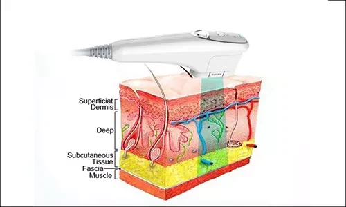 HIFU Facial Wrinkle Removal System Theory