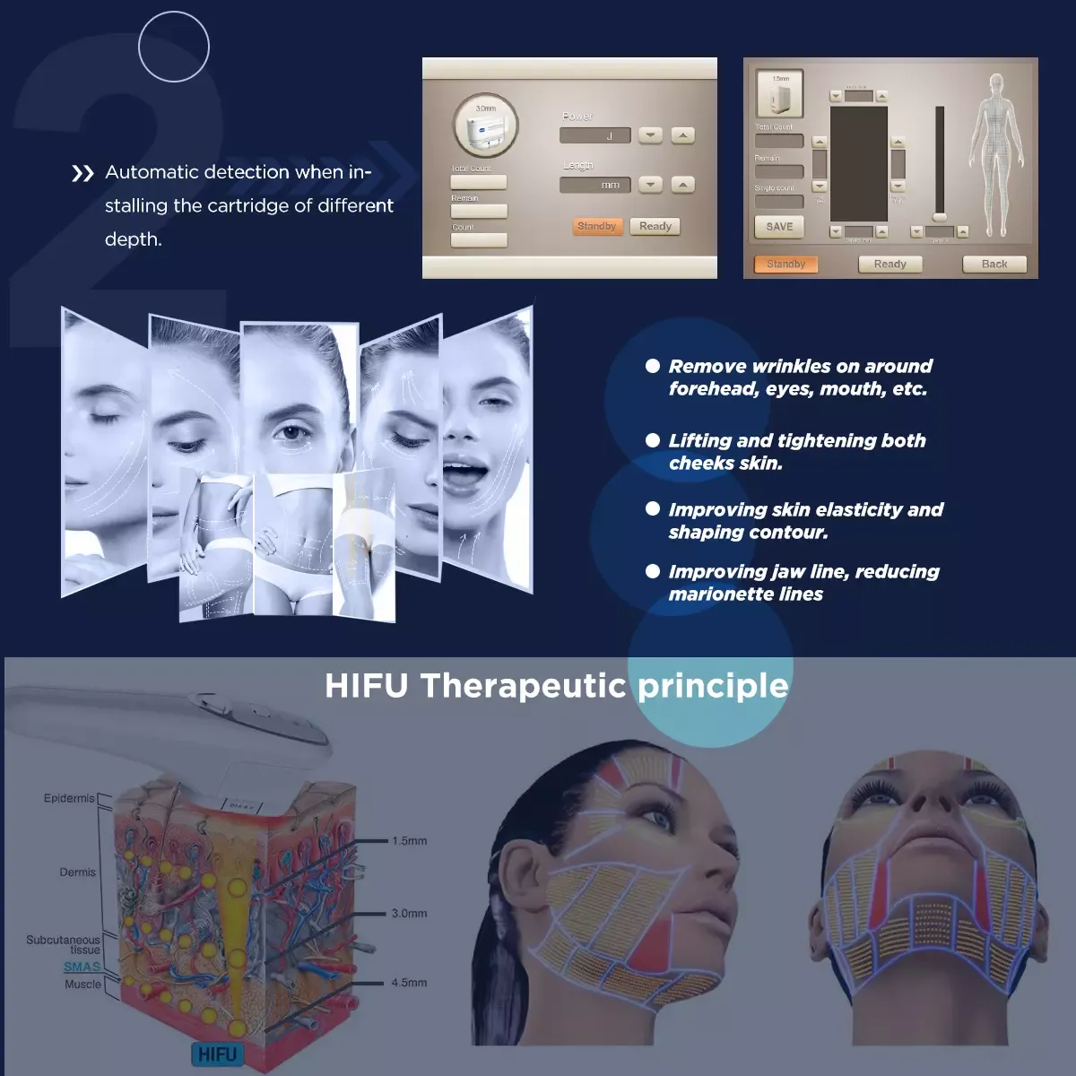 HIFU Facial Wrinkle Removal System Advantages