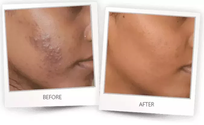 SHR Acne treatment Before and After SHR Acne treatment Before and After