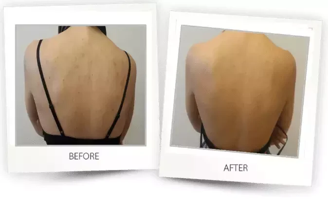 comparing photos before and after SHR acne removal treatment comparing photos before and after SHR acne removal treatment