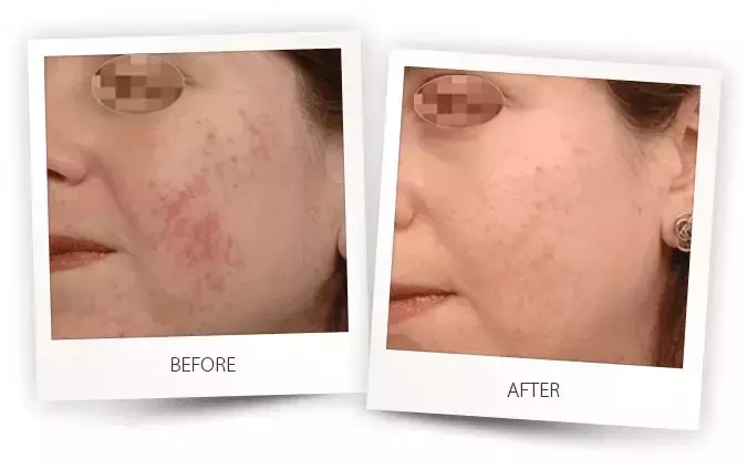 comparing photos before and after SHR acne removal treatment comparing photos before and after SHR acne removal treatment