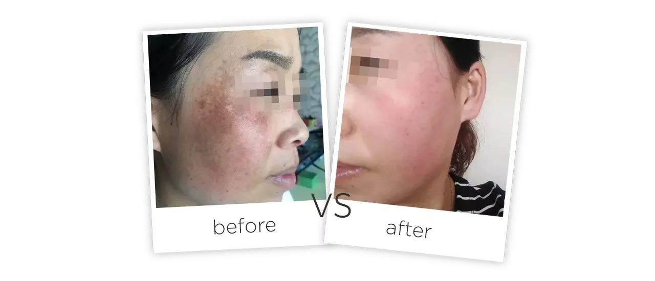 comparing images before and after SHR spots removal treatment