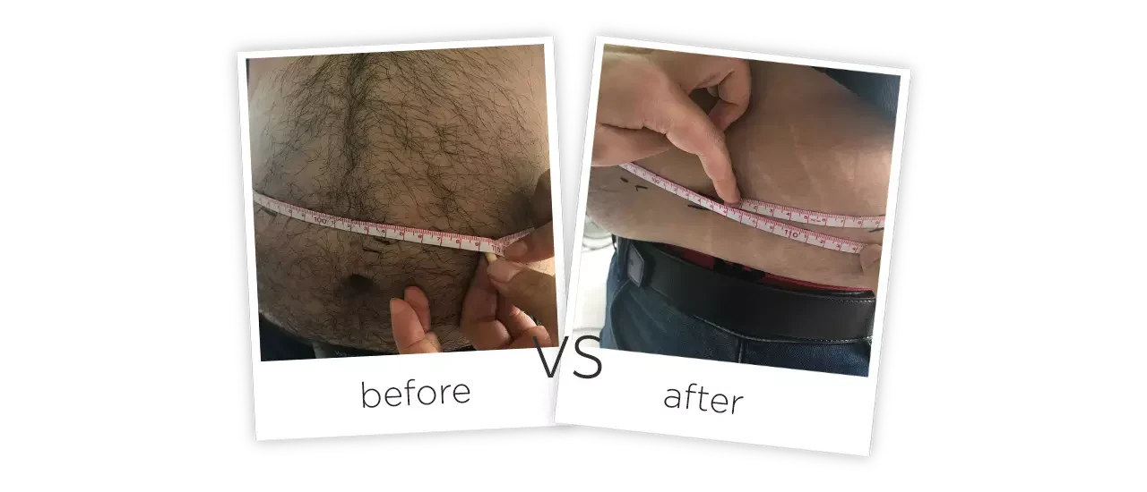 Laser Shape Body Slimming System Before&After