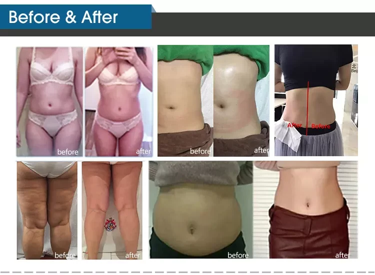 Laser Shape Body Slimming images