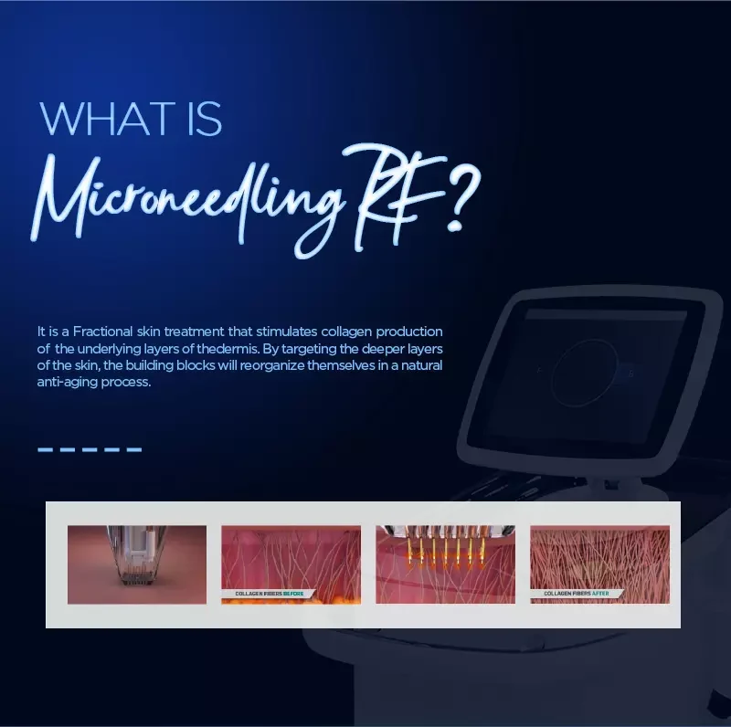 Microneedling RF