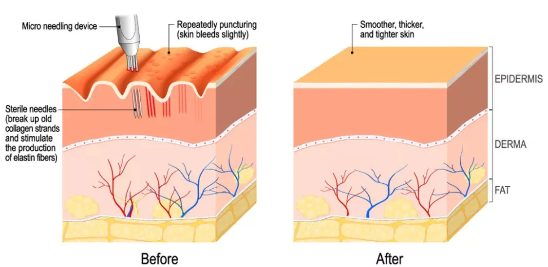 Microneedling RF Theory