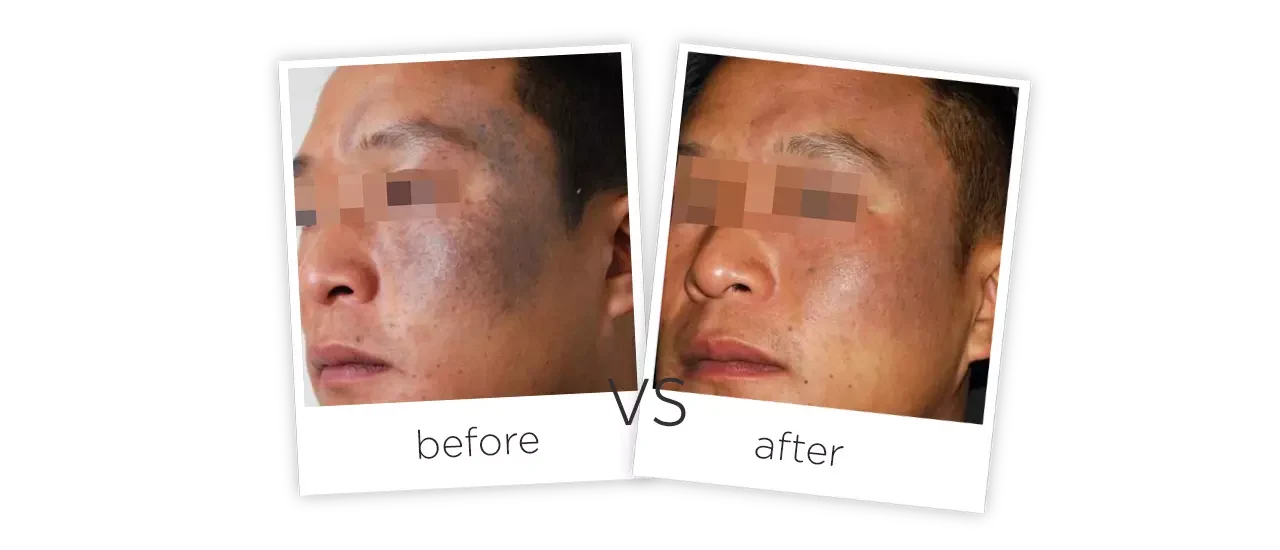 ND YAG Laser Tattoo Removal System,RY 280 Treatment Before&After