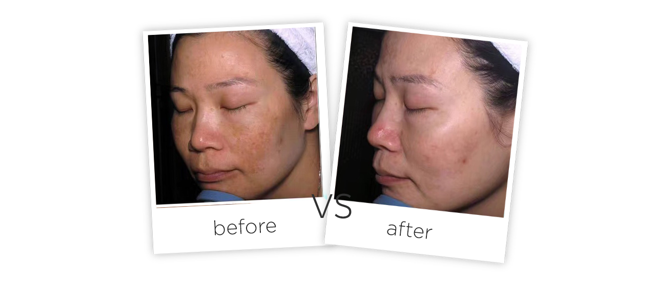 At Home Picosecond Laser Tattoo Removal Equipment Adss Laser Factory Direct Sales